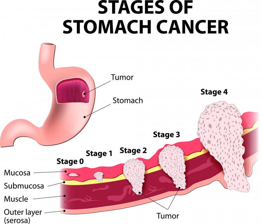 Staging of stomach cancer