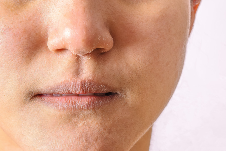 Allergic Women Have Eczema Dry Nose And Lips