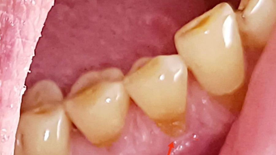 Δόντια - τερηδόνα 