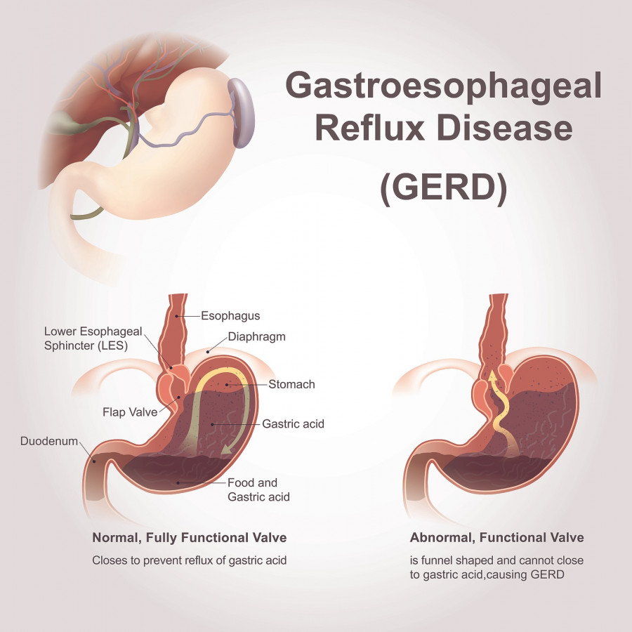Gastroesophageal reflux disease (GERD), also known as acid reflux