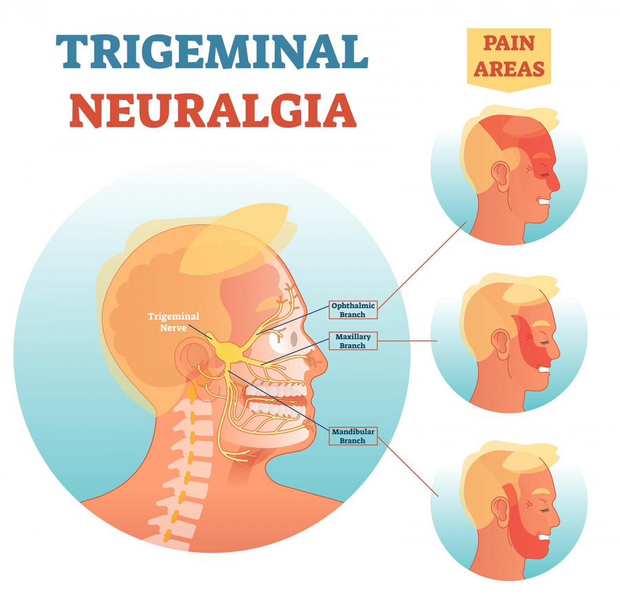 Trigeminal Neuralgia Medical Cross Section Anatomy