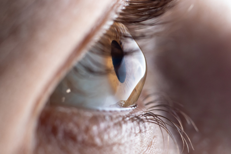Keratoconus - Eye Disease, Thinning Of The Cornea