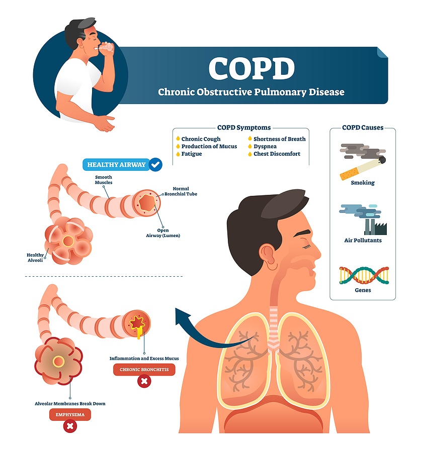 Copd Chronic Obstructive Pulmonary Disease