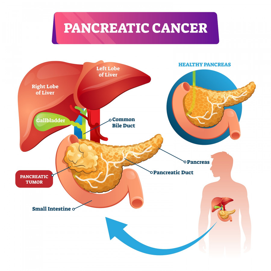 Pancreatic Cancer