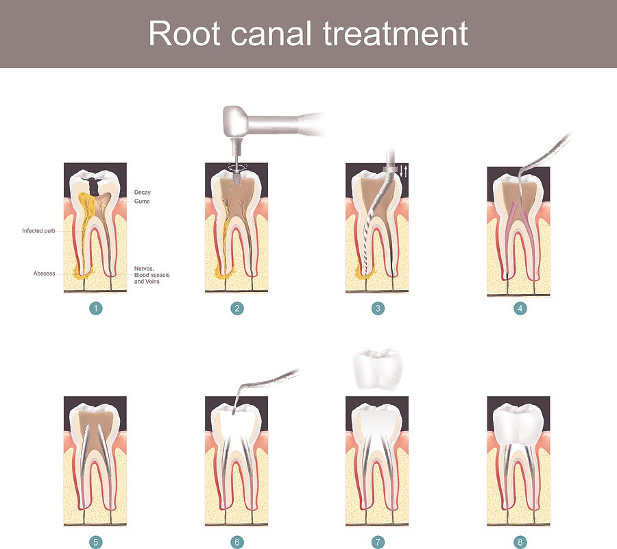 Root Canal Treatment