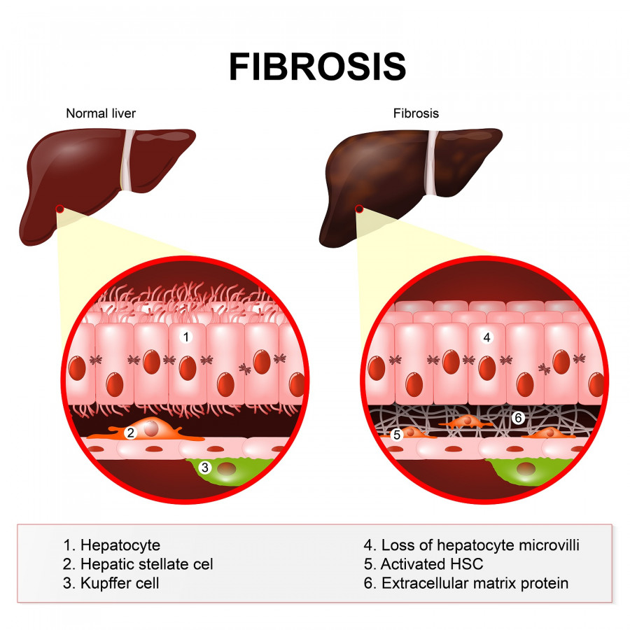 liver fibrosis
