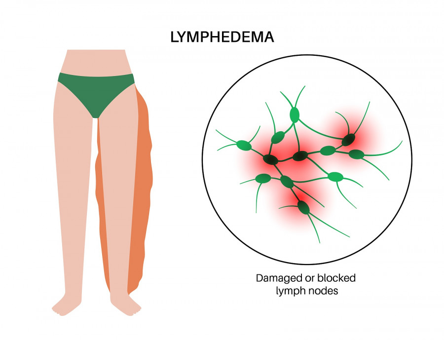 Lymphedema