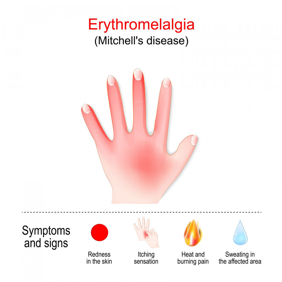 Erythromelalgia