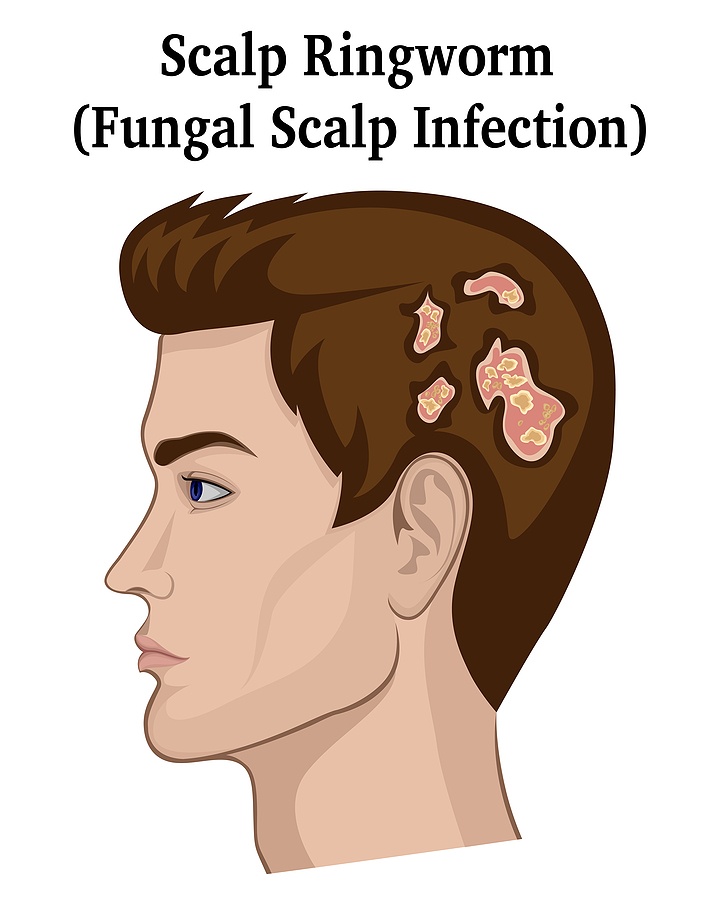 fungal infection of the scalp (ringworm, tinea capitis)