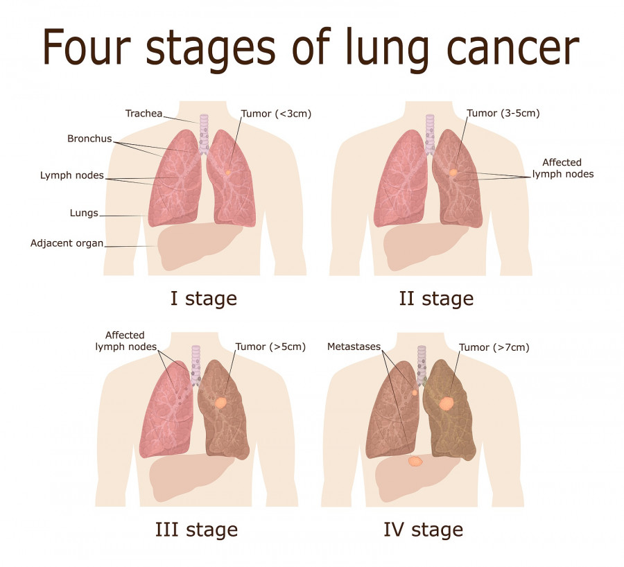 The Four Stages Of Lung Cancer