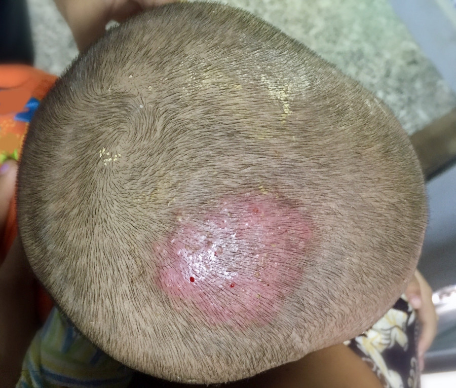 Tinea Capitis Or Fungal Infection On Scalp
