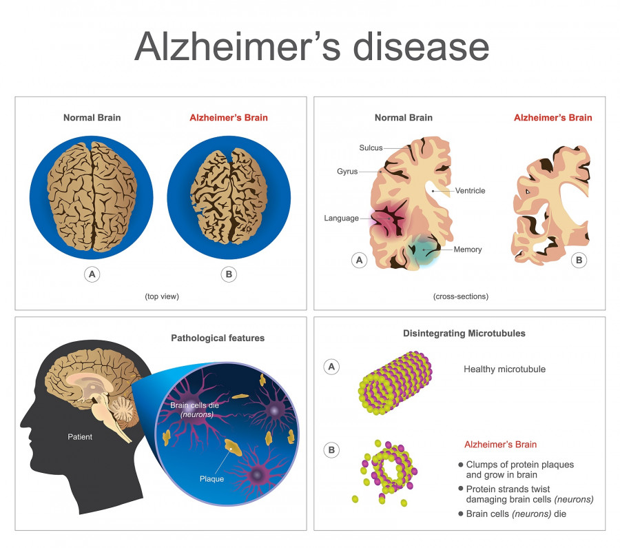 Alzheimer's Disease