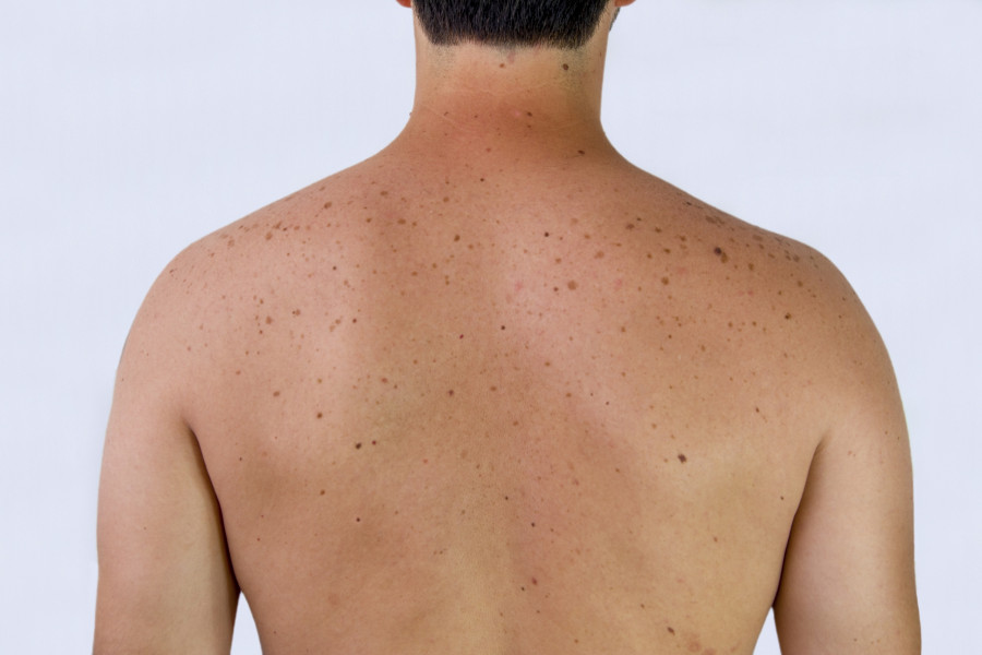 Sunspots, Skin, Back, Melanoma