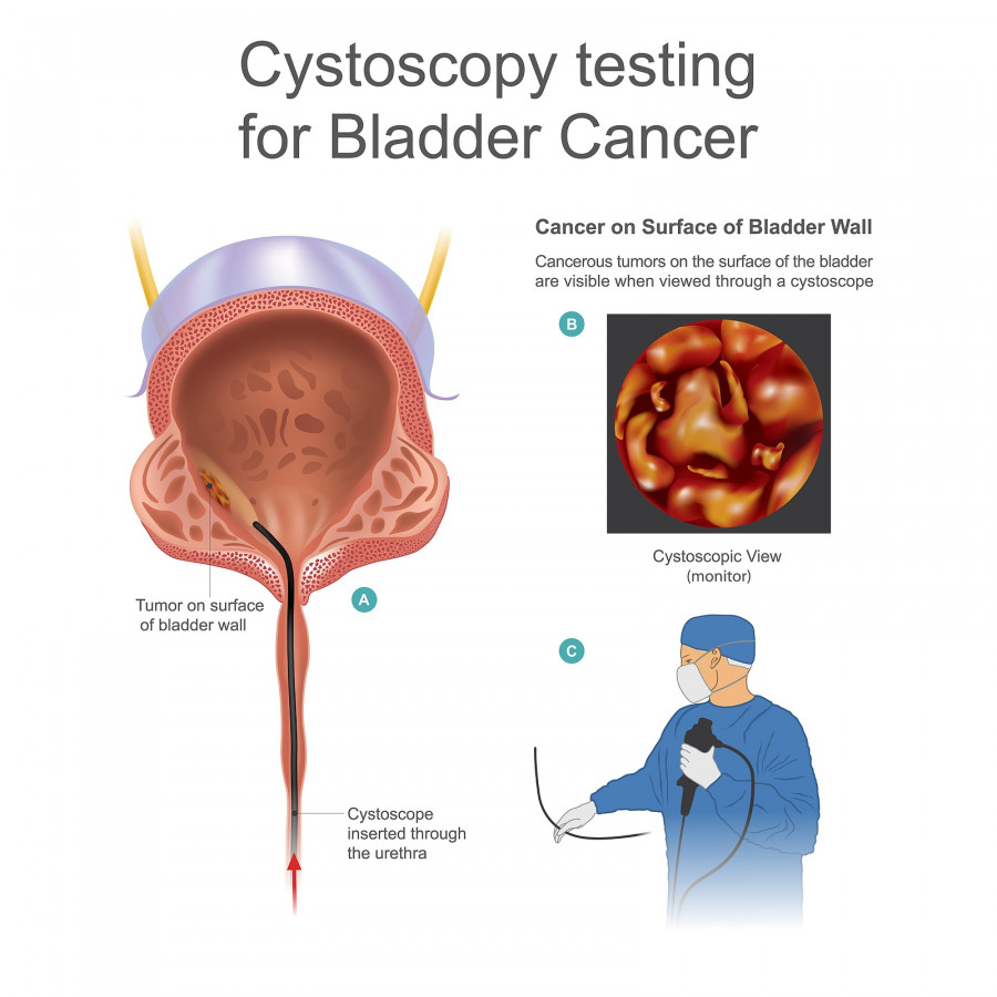 Bladder Cancer Cystoscopy