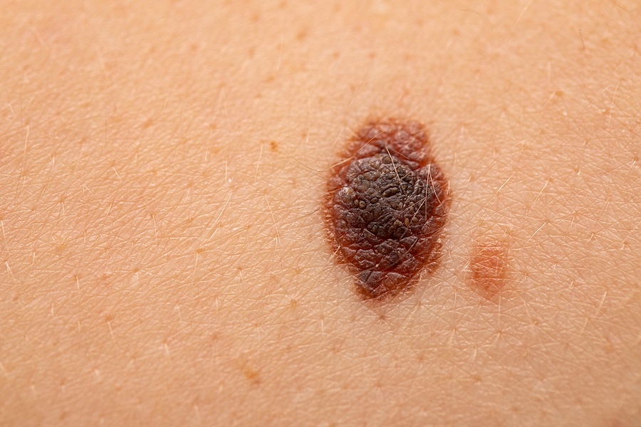 Close Up Picture Of Dangerous Brown Nevus On Human Skin - Melano