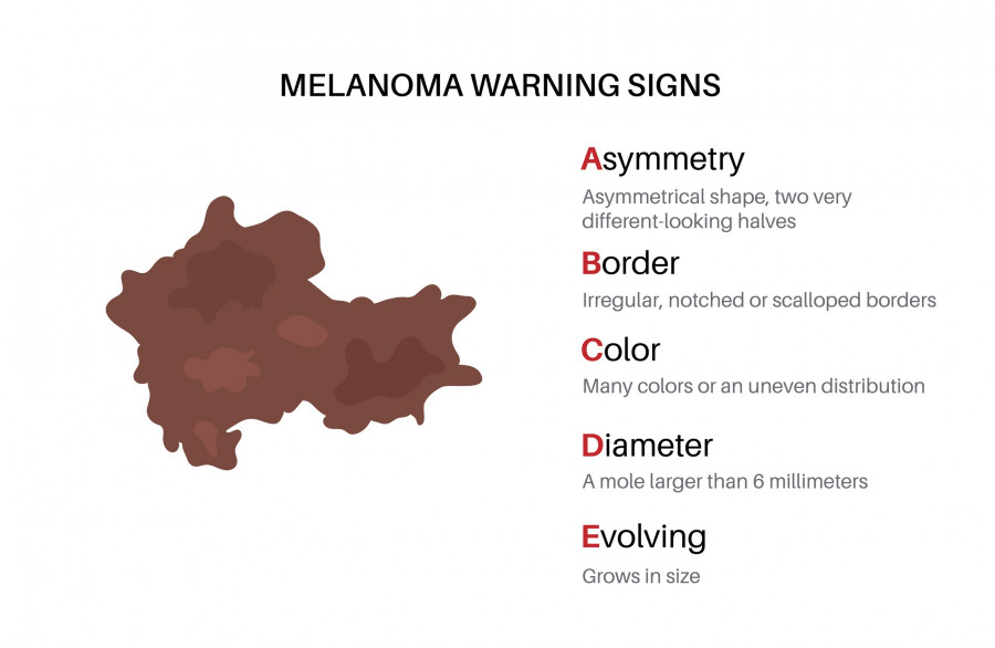 Melanoma Warning Signs. Abcde Rule For Skin Cancer. Asymmetrical