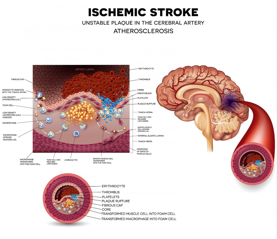 Ischemic stroke in the cerebral artery
