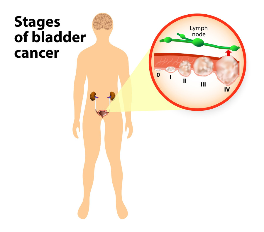 Stages Of Bladder Cancer
