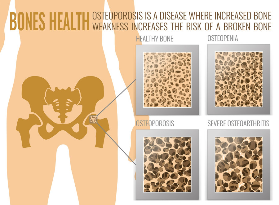 Four Stages Of Osteoporosis
