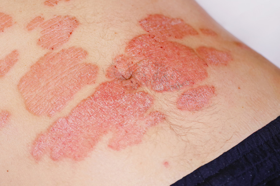 Acute Psoriasis On The Stomach In A Man