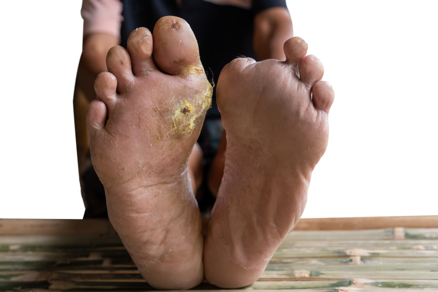 Diabetic Foot
