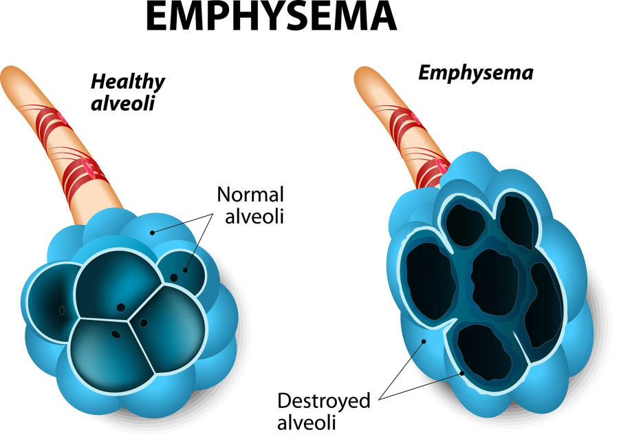 Emphysema