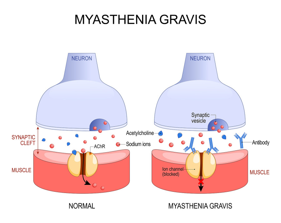 Myasthenia Gravis. Autoimmune Disease