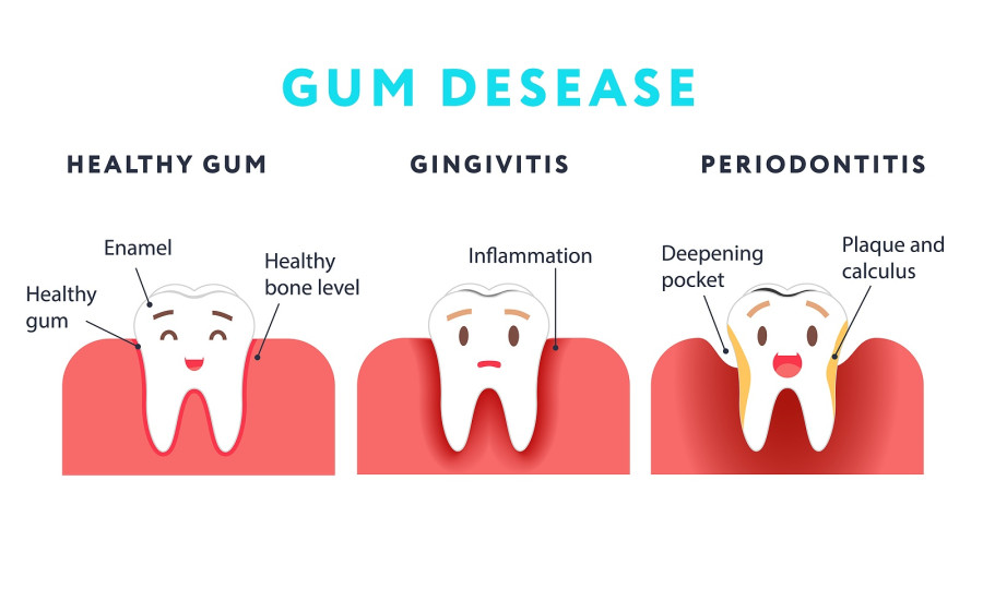 Gum Disease. Healthy Tooth And Gingivitis