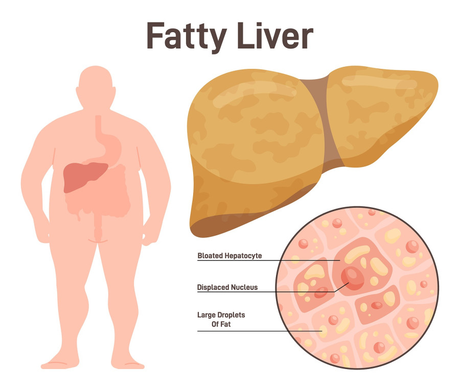 Fatty Liver Disease, Nafld. Extra Fat In The Liver