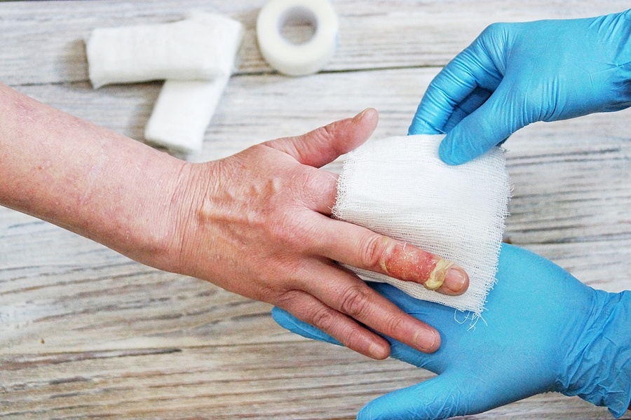 Bandage With The Medicine On Burn