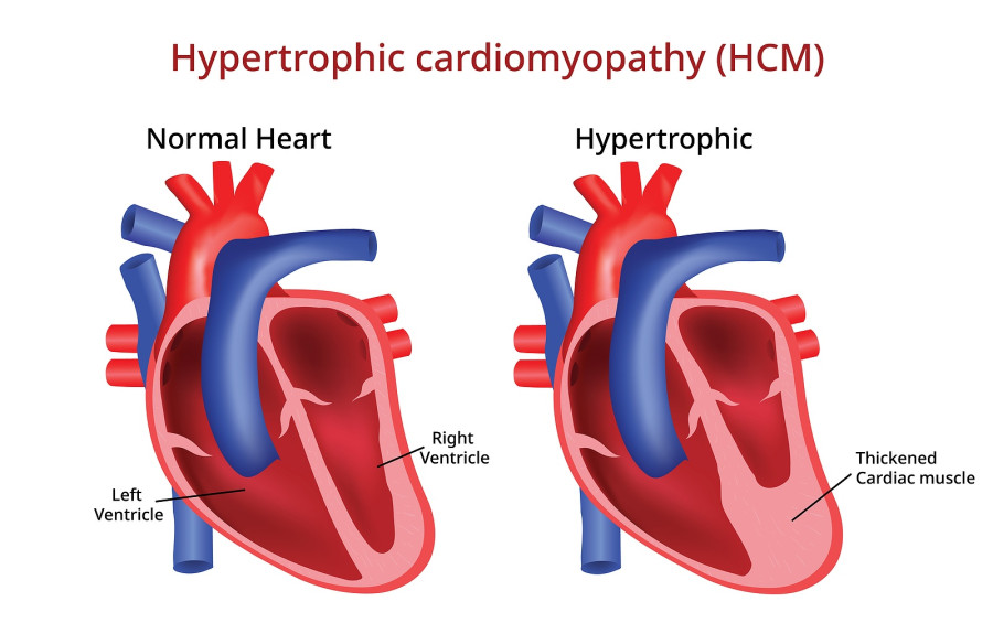 Hypertrophic Cardiomyopathy
