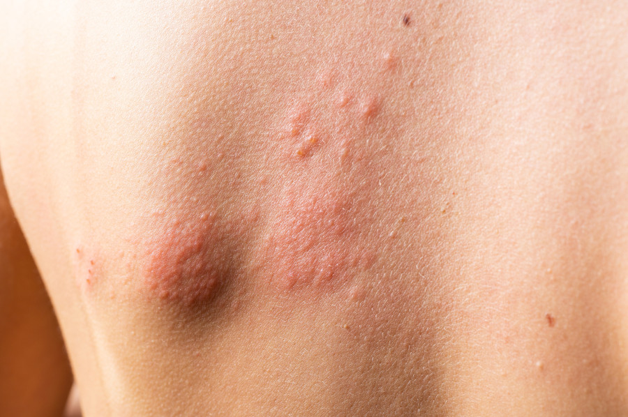 Chickenpox Rash. Shingles, Varicella-zoster Virus. Skin Rash