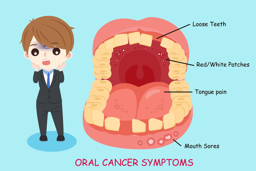 Oral Cancer Symptoms