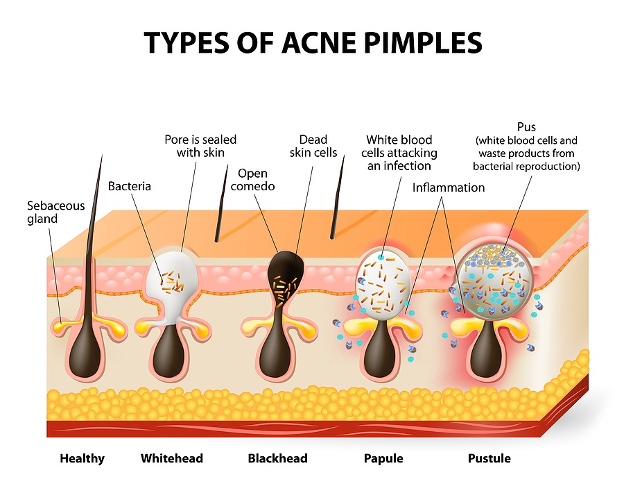 Types Of Acne Pimples