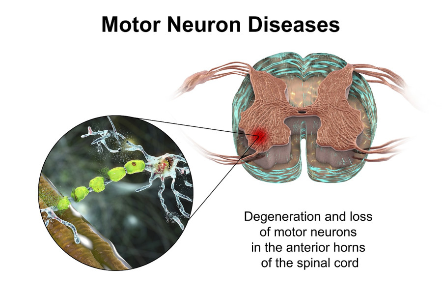 Motor Neuron Diseases