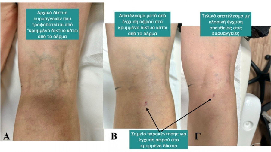 Ευρυαγγείες 
